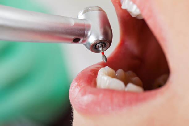 Best Emergency Dental Extractions in Spout Springs, NC